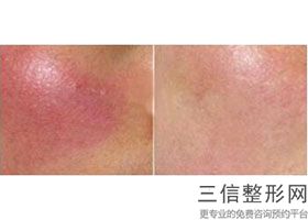 上海除皱做大拉皮美容大概收费标准(2022年09月除皱做大拉皮均价为：4517元)