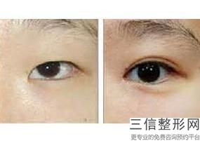 上海传统纹眼线整形正常价位(2022年09月传统纹眼线均价为：4531元)