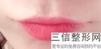 上海唇部微笑美容具体价格参考(2022年09月唇部微笑均价为：4425元)