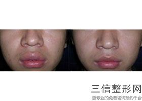上海唇部微笑整容多少钱(2022年09月唇部微笑均价为：4500元)