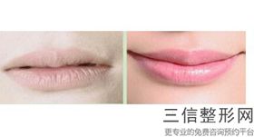 上海唇部修复整形价格为什么不一样(2022年09月唇部修复均价为：4445元)