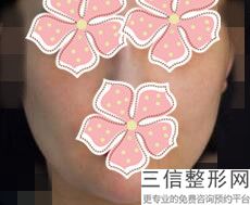 上海唇腭裂整形费用是多少钱(2022年09月唇腭裂均价为：4574元)