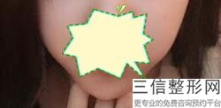 上海唇腭裂整形美容费用要多少(2022年09月唇腭裂整形均价为：4501元)