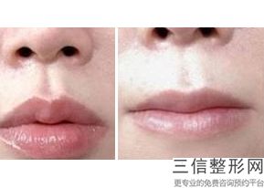 上海唇峰唇珠整形手术整形大约费用多少(2022年09月唇峰唇珠整形手术均价为:4342元)
