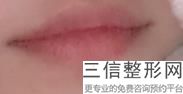 上海唇颊部缺损修复整形整容正常价格标准(2022年09月唇颊部缺损修复整形均价为：4530元)