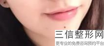 上海唇裂畸形手术美容费用需要多少(2022年09月唇裂畸形手术均价为：4718元)