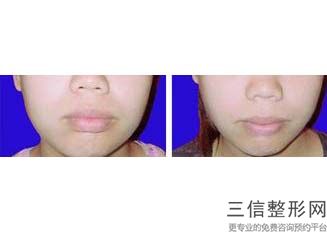上海唇裂畸形手术整容的价格是多少钱(2022年09月唇裂畸形手术均价为：4499元)
