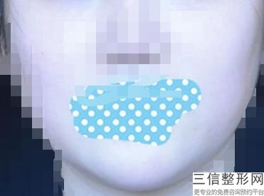 上海唇裂修复整容多少钱进口(2022年09月唇裂修复均价为：4642元)