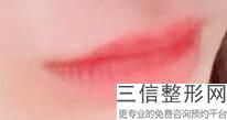 上海唇裂整容价格怎么样(2022年09月唇裂均价为：4653元)