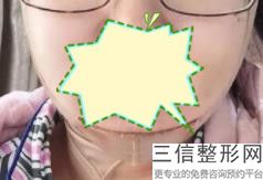 上海唇色暗黑美容多少钱大揭秘(2022年09月唇色暗黑均价为：4337元)
