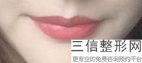 上海唇色偏黑整容多少钱能做(2022年09月唇色偏黑均价为：4469元)