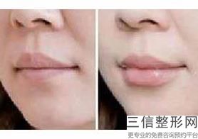 上海唇系带切除美容现在价位(2022年09月唇系带切除均价为:4328元)