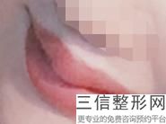 上海唇珠成型美容通常价格(2022年09月唇珠成型均价为：4521元)