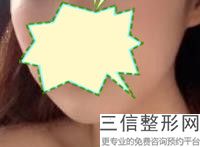 上海唇珠成形整容大概市场价格(2022年09月唇珠成形均价为：4467元)