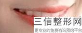 上海唇珠成形整容价格(2022年09月唇珠成形均价为：4518元)