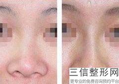 上海达拉斯美鼻美容价格怎样(2022年09月达拉斯美鼻均价为：4617元)