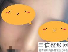 上海达拉斯综合隆鼻整形值多少钱(2022年09月达拉斯综合隆鼻均价为：4350元)
