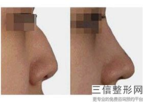 上海大鼻子整形手术整容一般要多少钱一次(2022年09月大鼻子整形手术均价为:4573元)