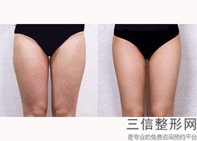 上海大腿侧吸整容具体价格多少钱(2022年09月大腿侧吸均价为：4590元)