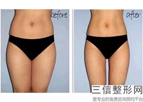 上海大腿超声吸脂美容全套多少钱(2022年09月大腿超声吸脂均价为：4568元)