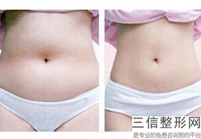 上海大腿超声吸脂整形价钱要多少(2022年09月大腿超声吸脂均价为：4418元)