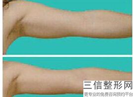 上海大腿超声吸脂整形价钱怎么样(2022年09月大腿超声吸脂均价为：4575元)