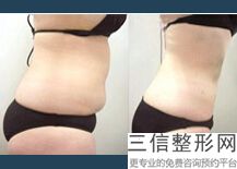 上海大腿抽脂整容多少钱能做好(2022年09月大腿抽脂均价为：4426元)