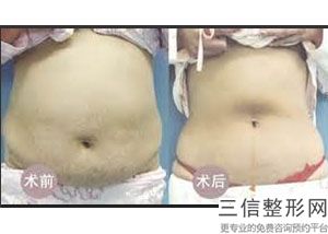 上海大腿共振吸脂整形多少钱大揭秘(2022年09月大腿共振吸脂均价为：4425元)