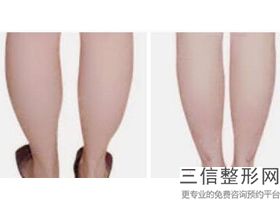 上海大腿环吸整容全套法事多少钱(2022年09月大腿环吸均价为：4589元)