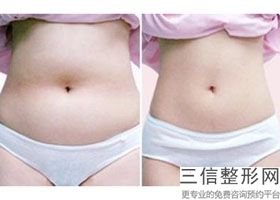 上海大腿环形吸脂美容一般价格多少钱(2022年09月大腿环形吸脂均价为：4321元)