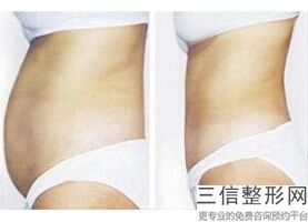 上海大腿减肥吸脂美容价钱表(2022年09月大腿减肥吸脂均价为：4629元)