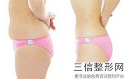 上海大腿射频溶脂美容价格到底多少呢(2022年09月大腿射频溶脂均价为：4495元)