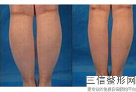 上海大腿吸脂整容一般费用范围(2022年09月大腿吸脂均价为：4450元)