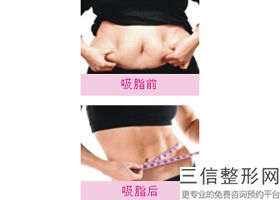 上海大腿吸脂整形大约费用范围(2022年09月大腿吸脂均价为：4655元)