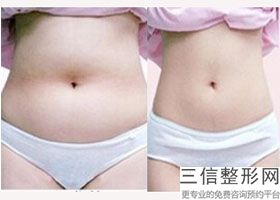 上海大腿吸脂整形一般价格参考(2022年09月大腿吸脂均价为：4420元)