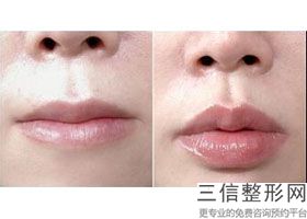 上海大阴唇整形整容通常价格参考(2022年09月大阴唇整形均价为：4455元)