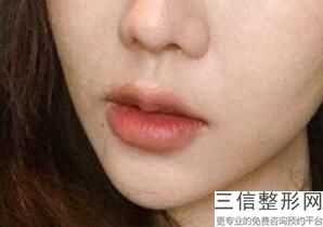 上海单侧唇裂修复整容现在收费标准(2022年09月单侧唇裂修复均价为：4646元)