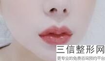 上海单侧兔唇治疗整容大约需要多少钱(2022年09月单侧兔唇治疗均价为：4544元)