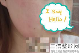 上海单侧兔唇治疗整容多少钱贵不贵(2022年09月单侧兔唇治疗均价为：4434元)