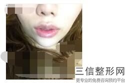 上海单侧兔唇治疗整形一般价格参考(2022年09月单侧兔唇治疗均价为：4488元)