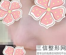 上海单纯隆鼻整容一般多少钱(2022年09月单纯隆鼻均价为：4509元)