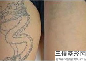 上海单眼皮做纹眼线整形价格范围(2022年09月单眼皮做纹眼线均价为：4437元)