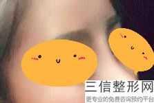 上海垫鼻梁美容具体价格(2022年09月垫鼻梁均价为：4492元)