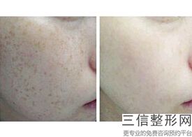 上海电波拉皮去眼袋整形通常是多少钱(2022年09月电波拉皮去眼袋均价为：4437元)