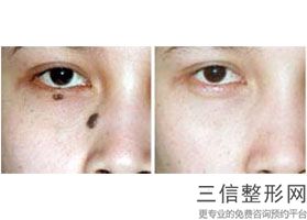 上海电波拉皮热玛吉整形的费用(2022年09月电波拉皮热玛吉均价为：4534元)