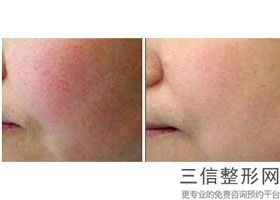 上海电波拉皮微创手术整形价格稳定吗(2022年09月电波拉皮微创手术均价为：4641元)