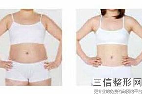上海电动负压吸脂瘦大腿整形价格哪里便宜(2022年09月电动负压吸脂瘦大腿均价为:4407元)