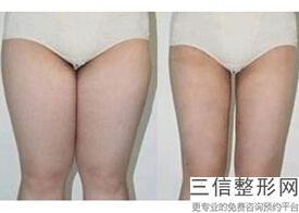 上海电子吸脂瘦大腿美容平均收费标准(2022年09月电子吸脂瘦大腿均价为：4482元)