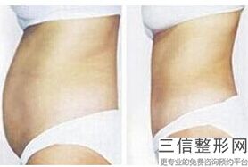 上海冬季丰胸整容价格参考(2022年09月冬季丰胸均价为：4760元)