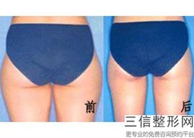 上海动氧瘦腹部整形的价格怎么样呢(2022年09月动氧瘦腹部均价为：4401元)
